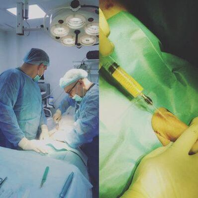 L'épaississement du pénis est possible avec l'aide de la chirurgie